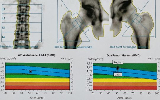 Knochendichte und Osteoporose: Warum die Knochendichtemessung eine wichtige Longevity Vorsorgeuntersuchung ist