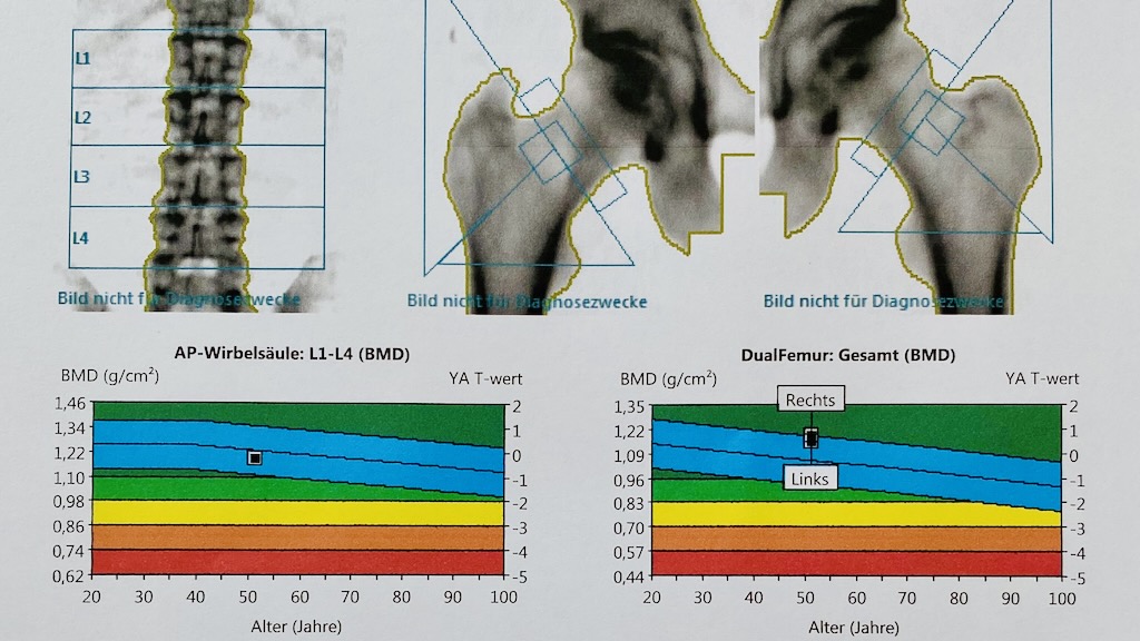 Knochendichte und Osteoporose: Exemplarische Abbildung der Auswertung einer Knochendichtemessung (Osteodensitometrie) mittels Dual-Röntgen-Absorptiometrie (DXA / DEXA) zur Einschätzung des persönlichen Osteoporose Risikos im Rahmen einer Longevity Vorsorgeuntersuchung.